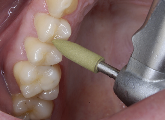 Shofu Dental | CompoMaster and CompoMaster Coarse | 115C