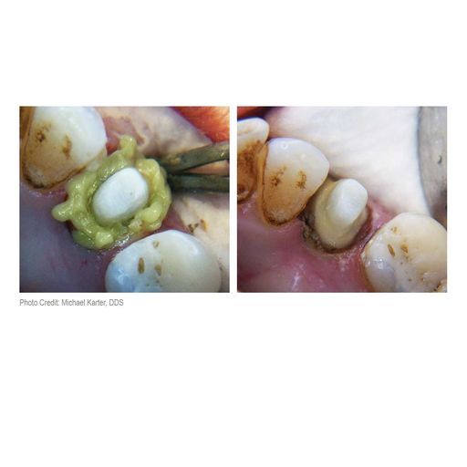 Parkell | Dryz Hemostatic Retraction Paste: 30 Capsules, 0.24g Each | S183