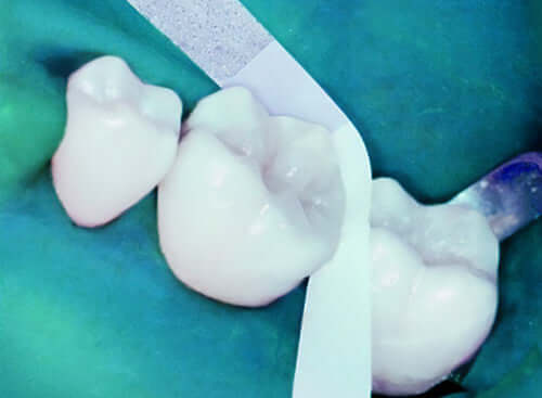 SeptoFipo Interproximal Strips, 2.5mm x 7", 100/Bx 01C4038