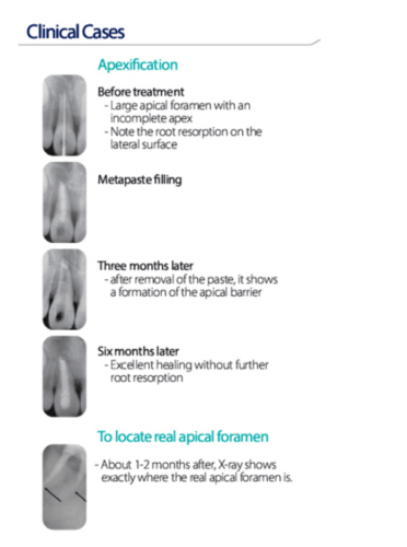 Meta Biomed | Meta Biomed METAPASTE PLUS Temporary Root Canal Filling Material, Calcium Hydroxide with Barium | 301002