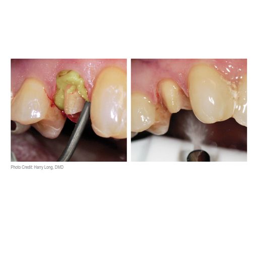 Parkell | Dryz Retraction Paste - Syringes Green (7pcs) | S180