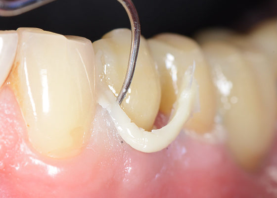 Cements and tooth prep