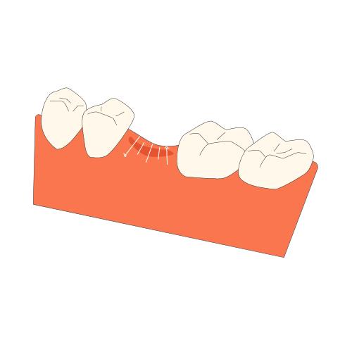 Dental Sutures