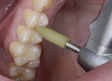 Shofu Dental | CompoMaster and CompoMaster Coarse | 0115