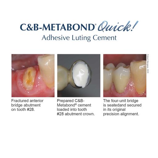 Parkell | C&B Metabond Adhesive Cement System | S380