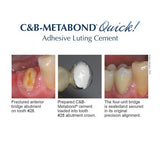 Parkell | C&B Metabond Adhesive Cement System | S380