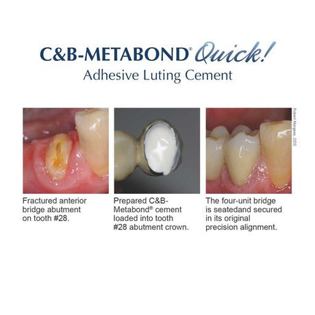 Parkell | C&B Metabond Adhesive Cement System | S380