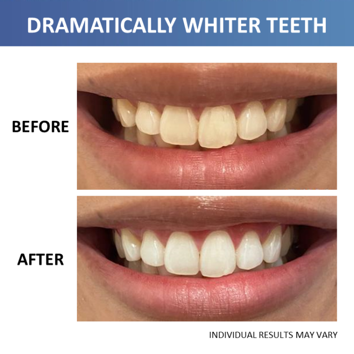 Crest 3D Whitestrips Professional Effects, 20 treatments